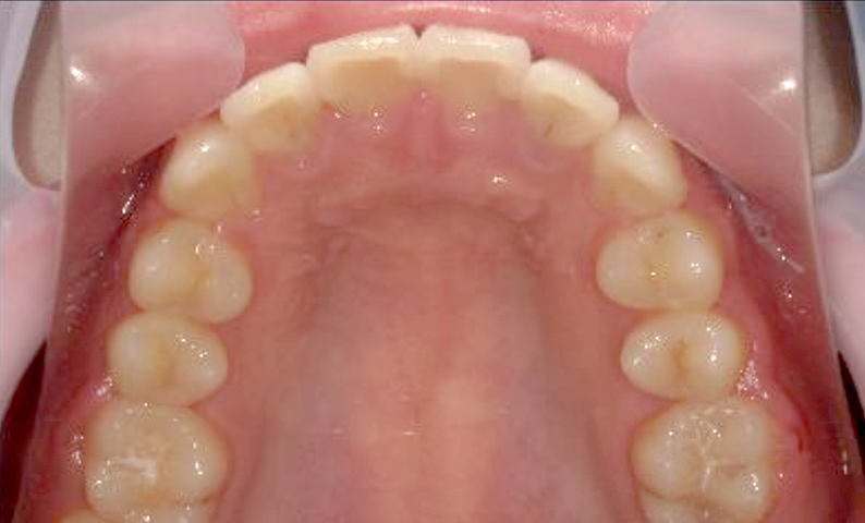 部分矯正 出っ歯の部分矯正の症例写真