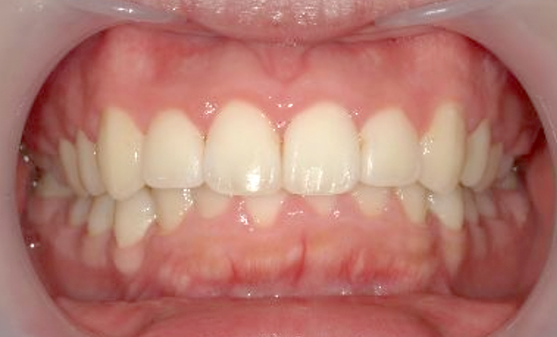 部分矯正 出っ歯の部分矯正の症例写真