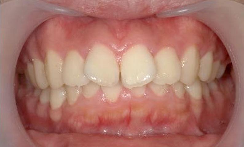 部分矯正 出っ歯の部分矯正の症例写真