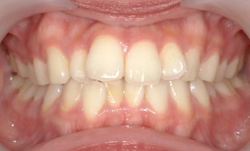 部分矯正 出っ歯の症例写真