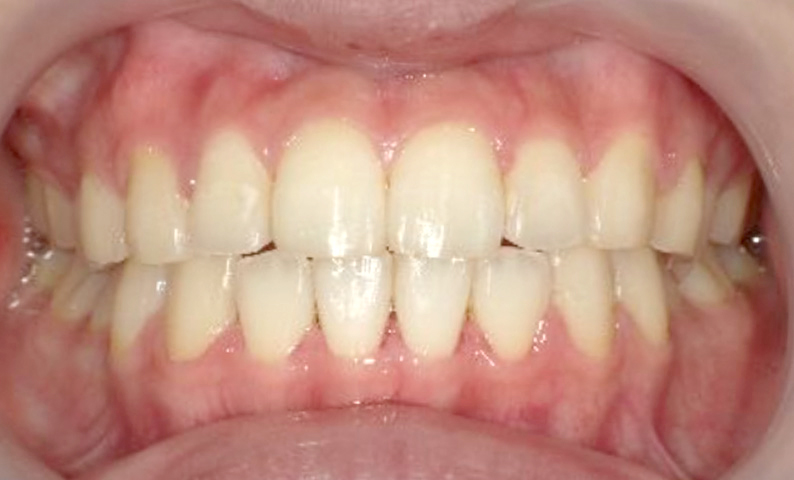 部分矯正 出っ歯の症例写真