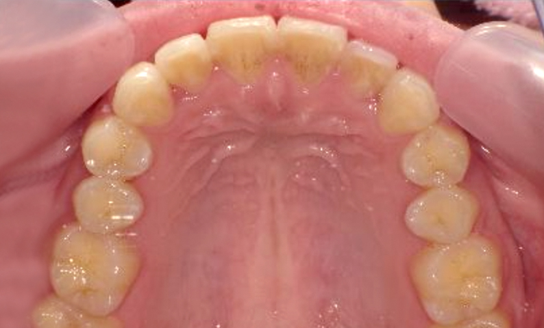 部分矯正 出っ歯の症例写真