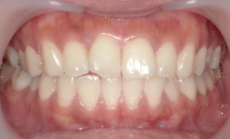 部分矯正 出っ歯の症例写真