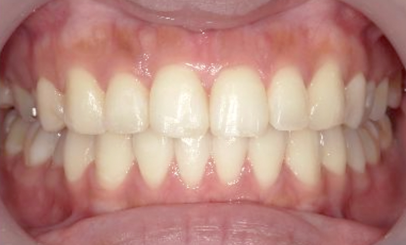 部分矯正 出っ歯の症例写真