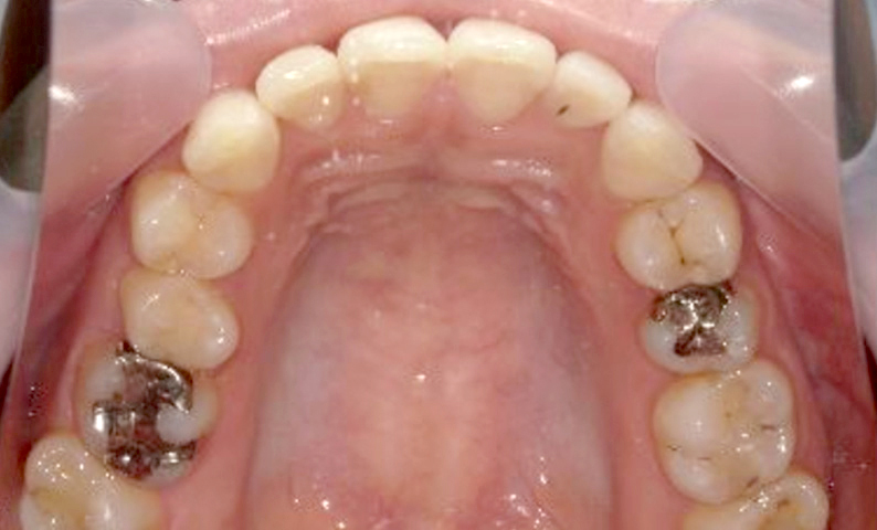 部分矯正 出っ歯の症例写真