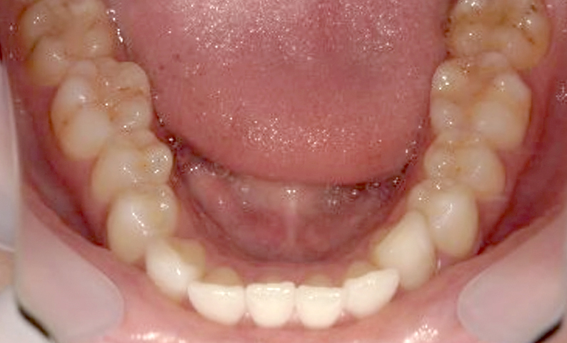 部分矯正 出っ歯の症例写真
