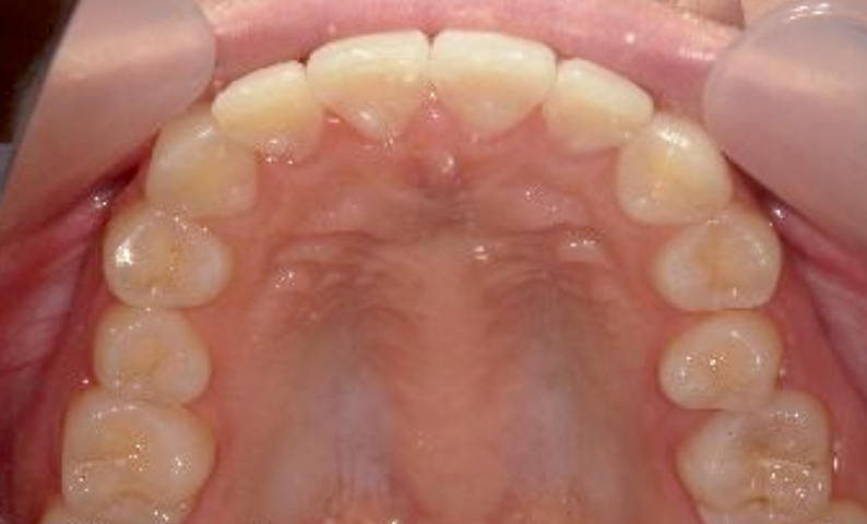 部分矯正 出っ歯の症例写真