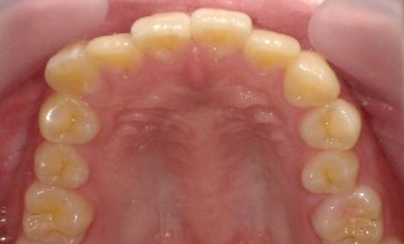 部分矯正 出っ歯の症例写真