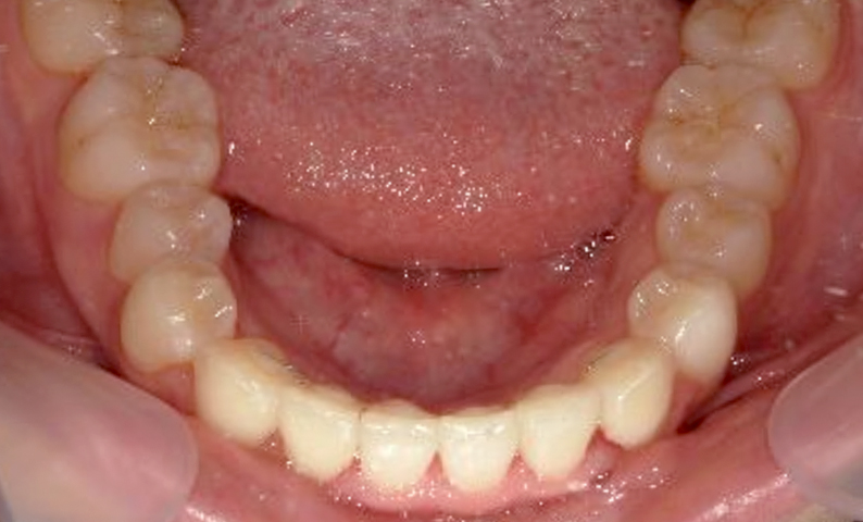 部分矯正 出っ歯の症例写真