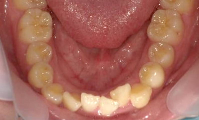 部分矯正 出っ歯の症例写真
