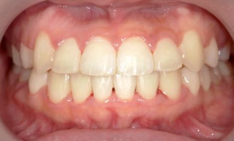 部分矯正 出っ歯の症例写真