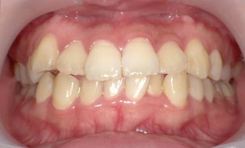 部分矯正 出っ歯の症例写真