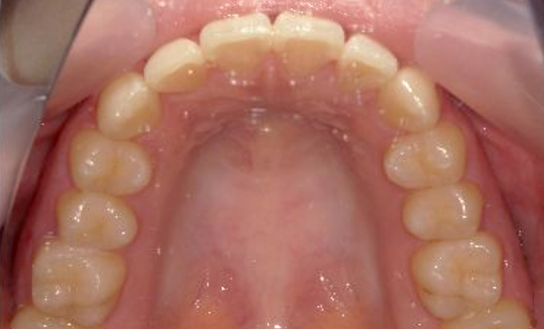 部分矯正 出っ歯の症例写真