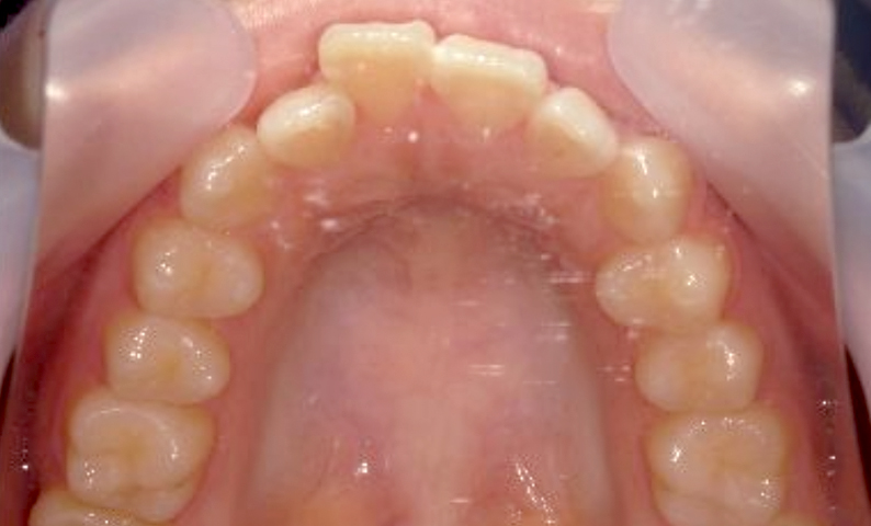 部分矯正 出っ歯の症例写真