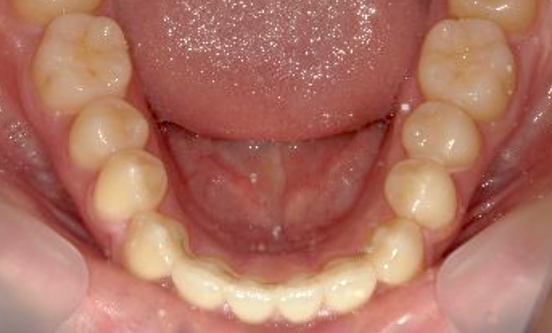 部分矯正 出っ歯の症例写真