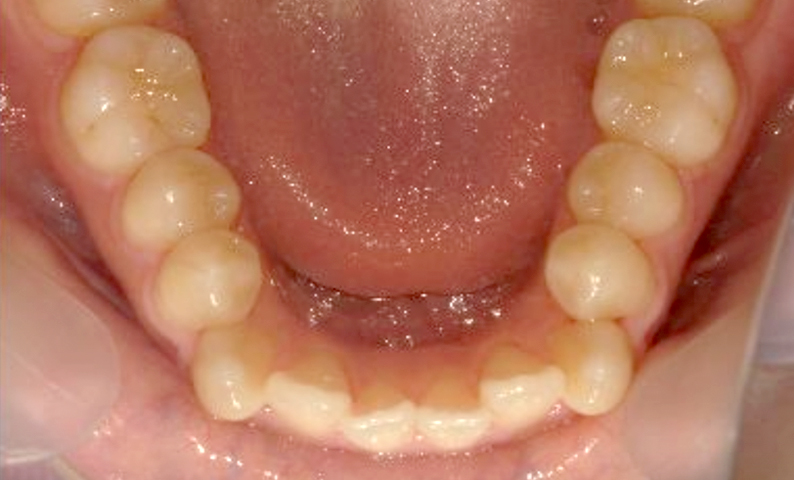 部分矯正 出っ歯の症例写真