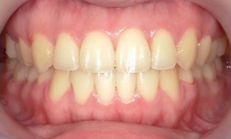 部分矯正 出っ歯の症例写真