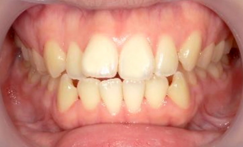 部分矯正 出っ歯の症例写真