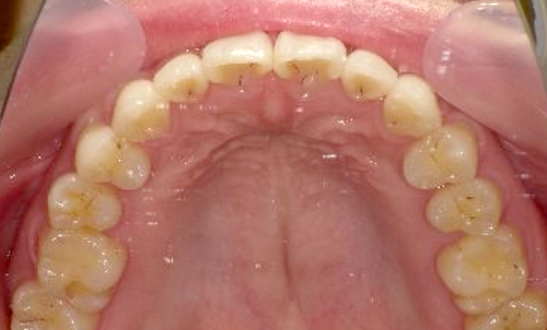 部分矯正 出っ歯の部分矯正の症例写真