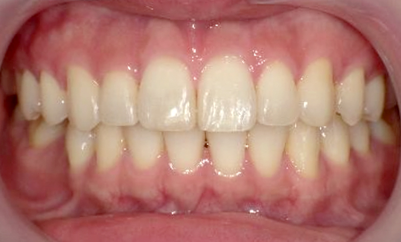 部分矯正 出っ歯の部分矯正の症例写真