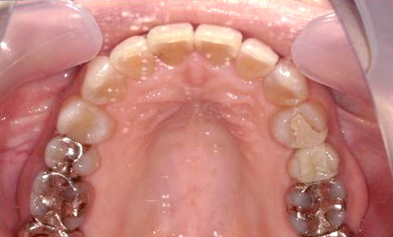 部分矯正 出っ歯の部分矯正の症例写真