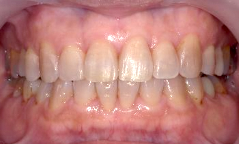 部分矯正 出っ歯の部分矯正の症例写真