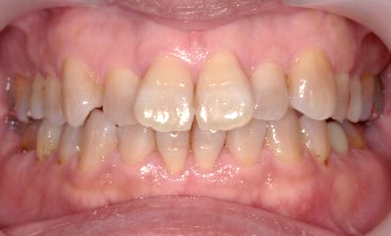 部分矯正 出っ歯の部分矯正の症例写真