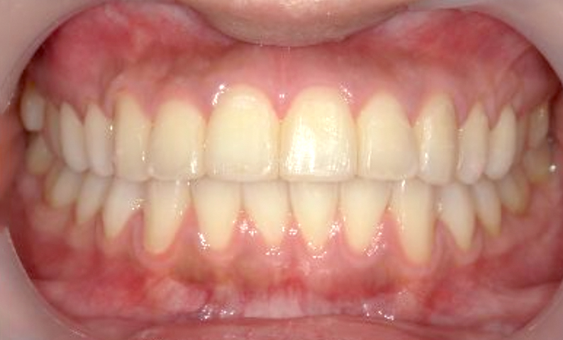 部分矯正 出っ歯の部分矯正の症例写真