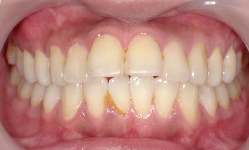 部分矯正 出っ歯の部分矯正の症例写真