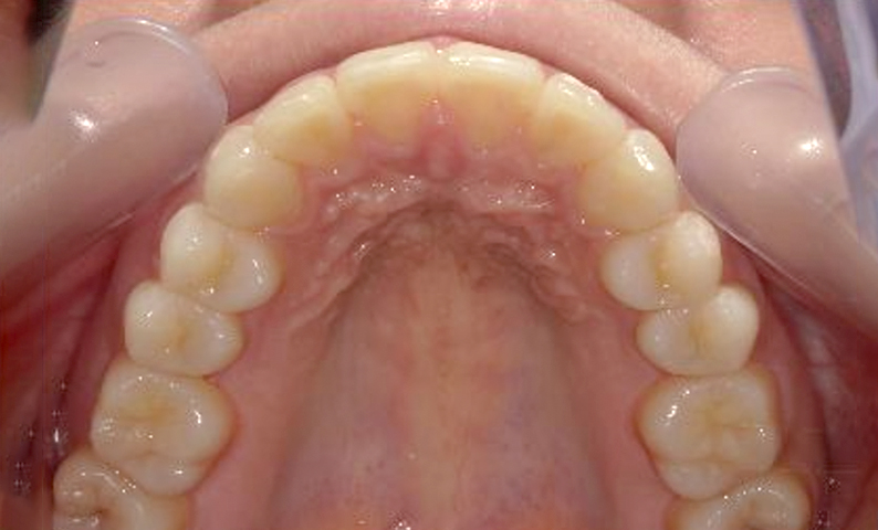 部分矯正 出っ歯の部分矯正の症例写真