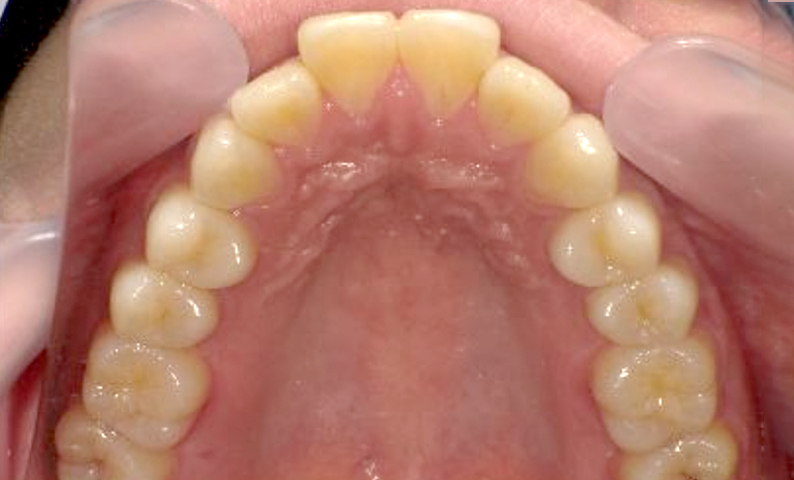 部分矯正 出っ歯の部分矯正の症例写真