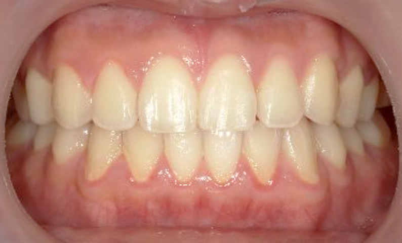 部分矯正 出っ歯の部分矯正の症例写真