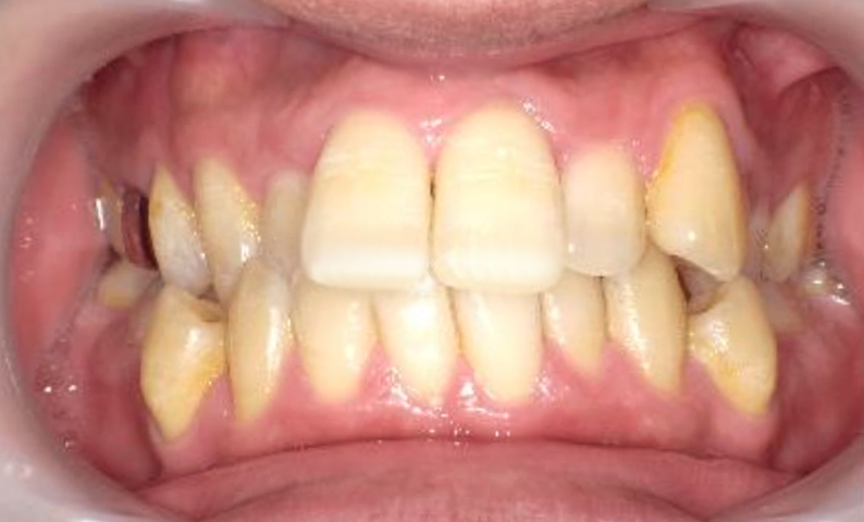 部分矯正 出っ歯の部分矯正の症例写真