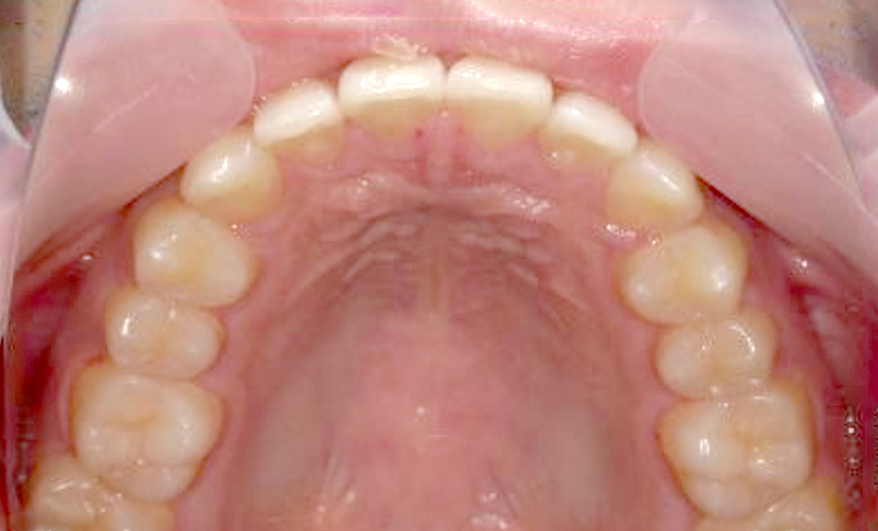 部分矯正 出っ歯の部分矯正の症例写真