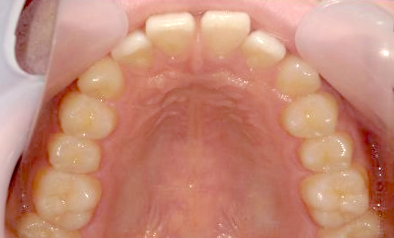 部分矯正 出っ歯の部分矯正の症例写真