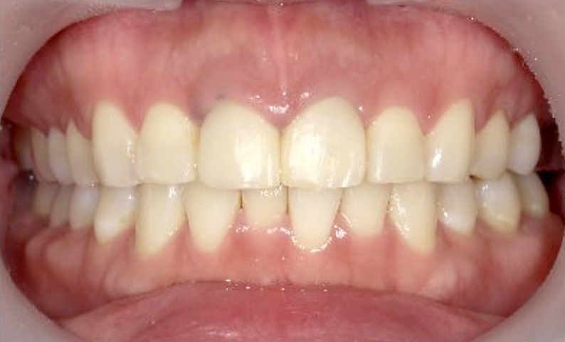 部分矯正 出っ歯の部分矯正の症例写真