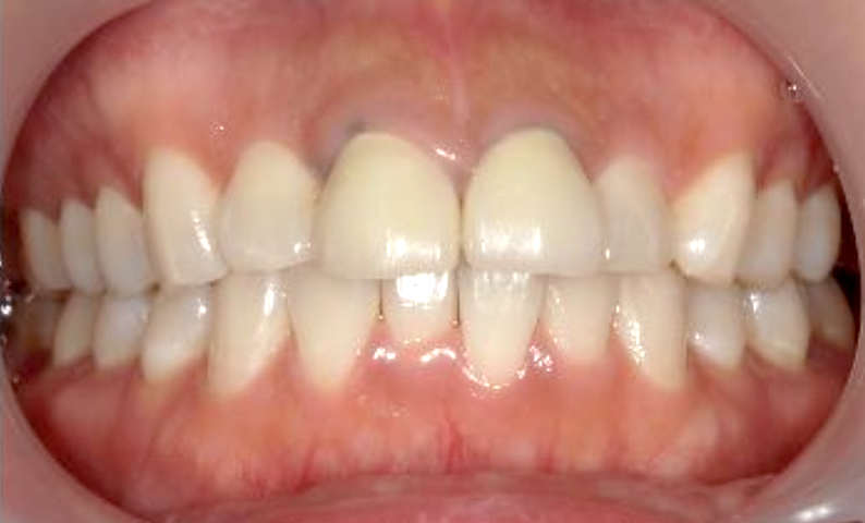 部分矯正 出っ歯の部分矯正の症例写真