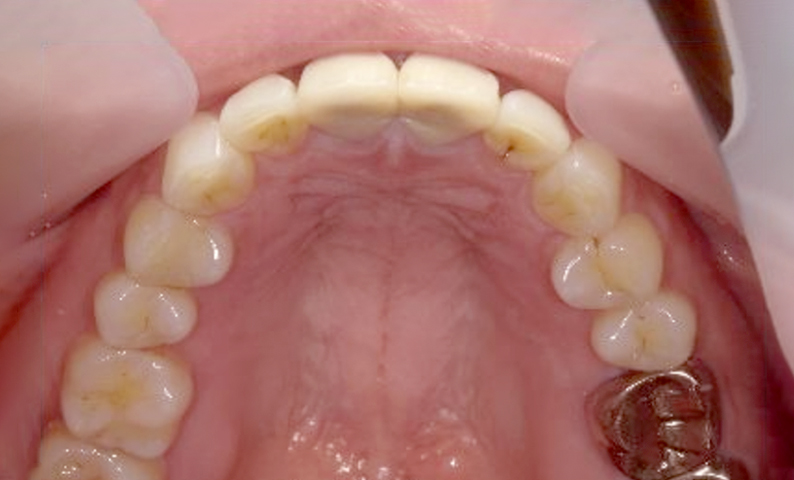 部分矯正 出っ歯の部分矯正の症例写真