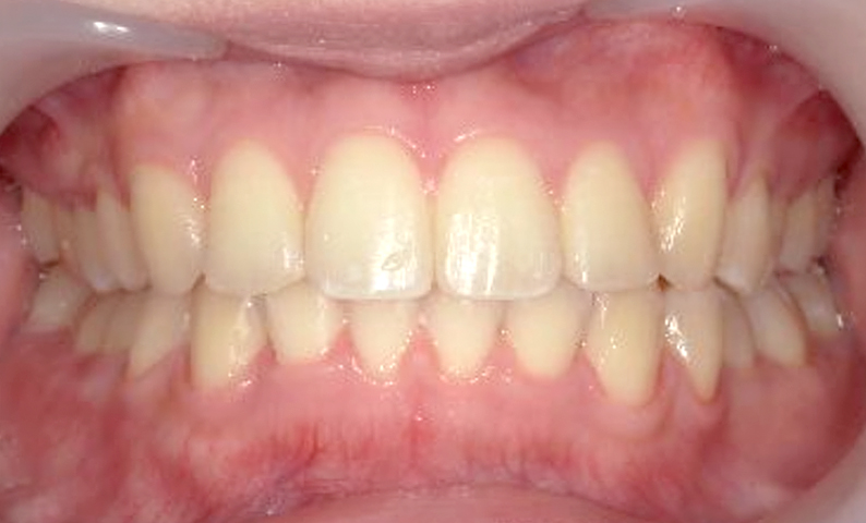 部分矯正 出っ歯の症例写真