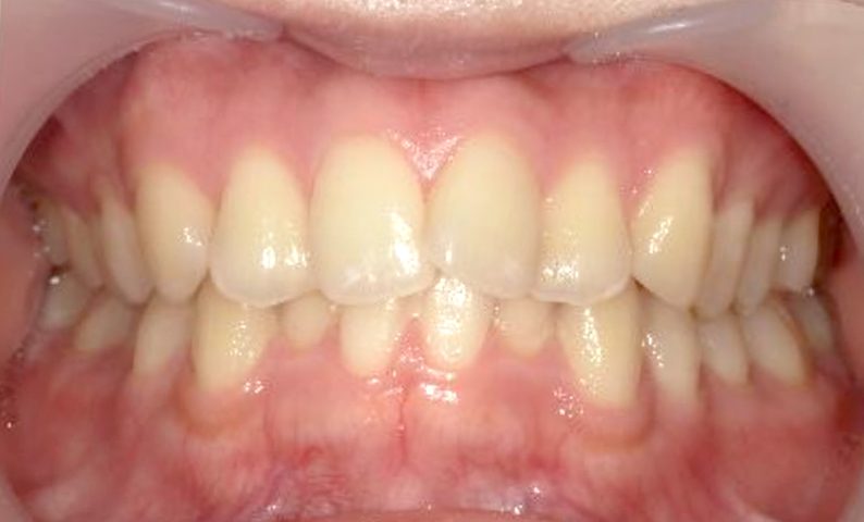 部分矯正 出っ歯の症例写真