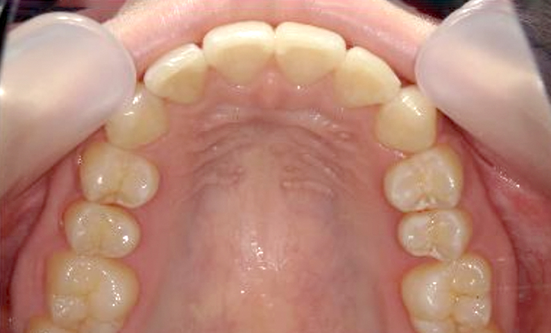 部分矯正 出っ歯の症例写真