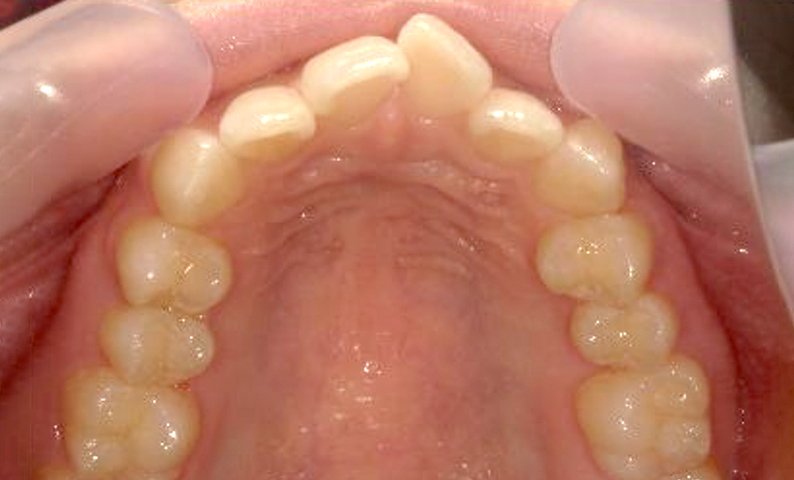 部分矯正 出っ歯の症例写真