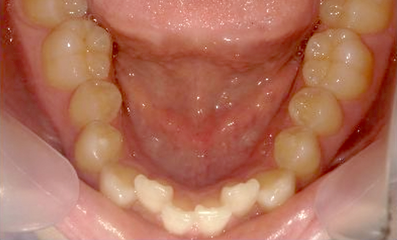部分矯正 出っ歯の症例写真