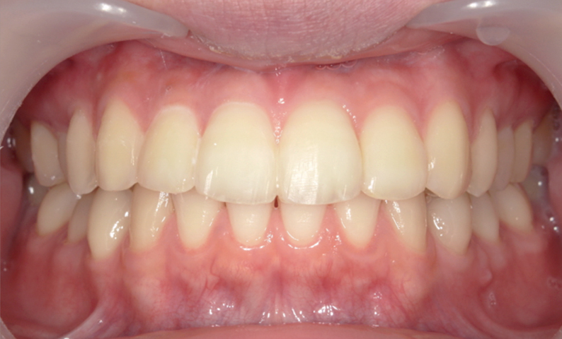 部分矯正 出っ歯の部分矯正の症例写真