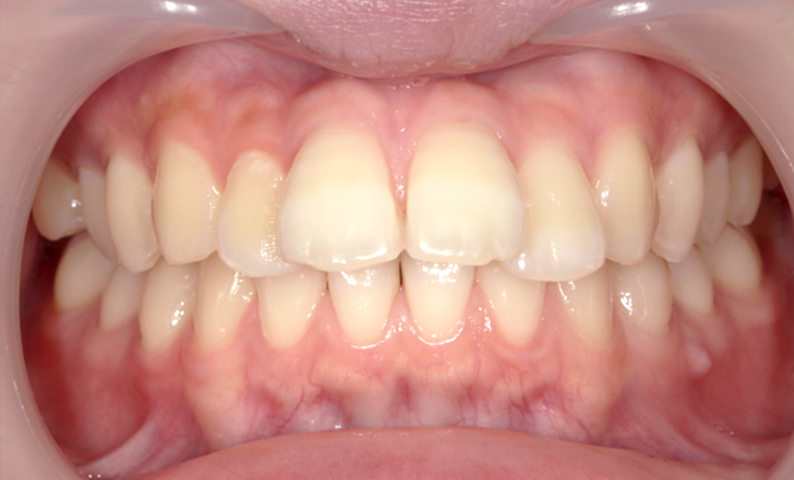 部分矯正 出っ歯の部分矯正の症例写真