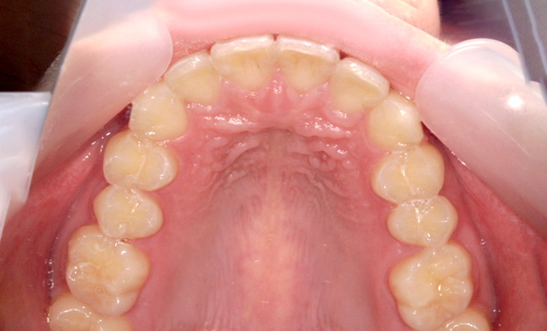 部分矯正 出っ歯の部分矯正の症例写真