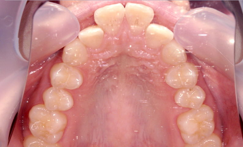 部分矯正 出っ歯の部分矯正の症例写真