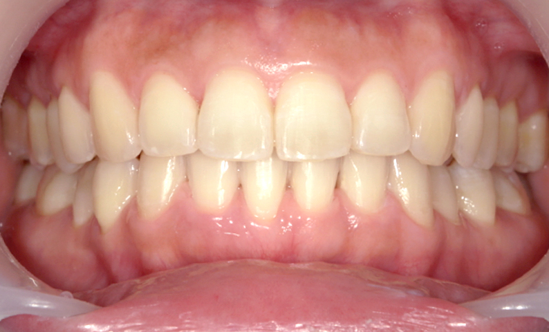 部分矯正 出っ歯の症例写真