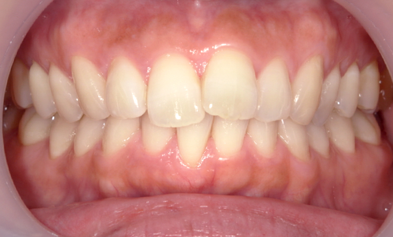 部分矯正 出っ歯の症例写真