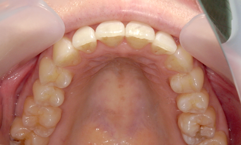 部分矯正 出っ歯の症例写真